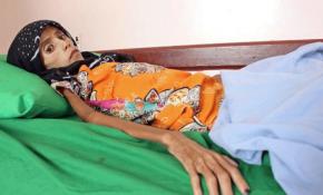 Yemen'deki insanlık dramının son örneği: 12 yaşında 10 kilo kalan Fatma