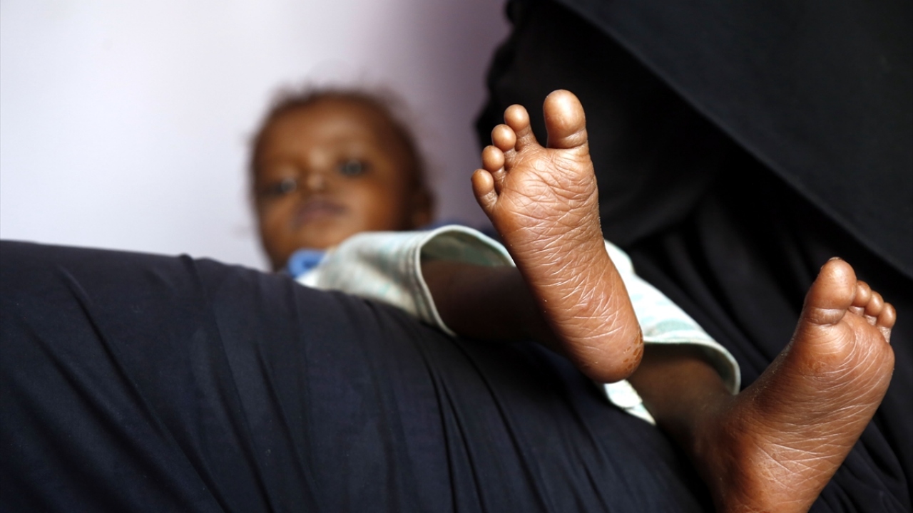 Kısıtlı imkanlar nedeniyle başta beslenme olmak üzere çeşitli sorunlar yaşayan çok sayıda Yemenli çocuk, başkent Sana`daki Sabaeen Hastanesinde tedavi ediliyor.