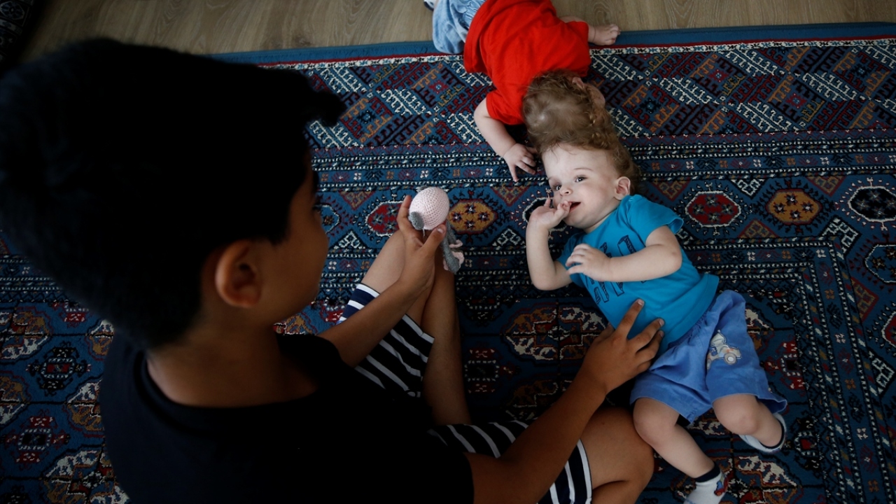 Aile, kafadan yapışık bebeklerini kucaklarına alıp doğru dürüst sevememenin de üzüntüsünü yaşıyor. 