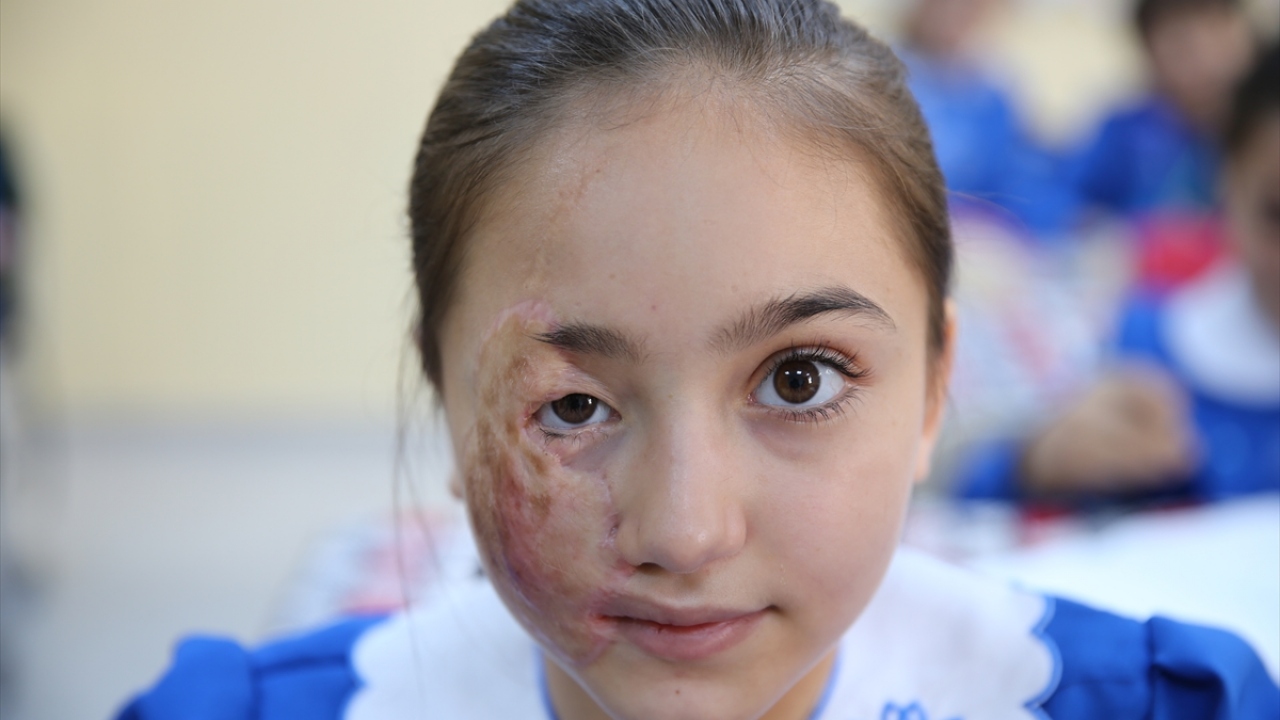 Savaş uçakları yüzünü yaktı