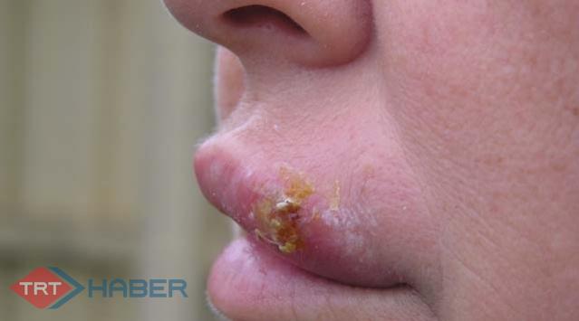 Herpes Beyni Tehdit Ediyor