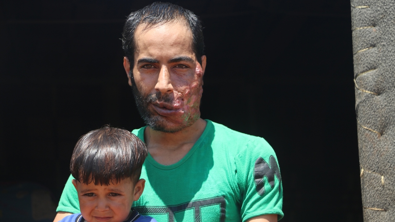 Muhammed, "Evlatlarımın yanına yaklaşamıyorum. Saldırıdan önce çocuklarımla oynardım, severdim şimdi ise kucaklayamıyorum benden ürperiyorlar. Beni gördüklerinde uzaklaşıyorlar." ifadesini kullandı.