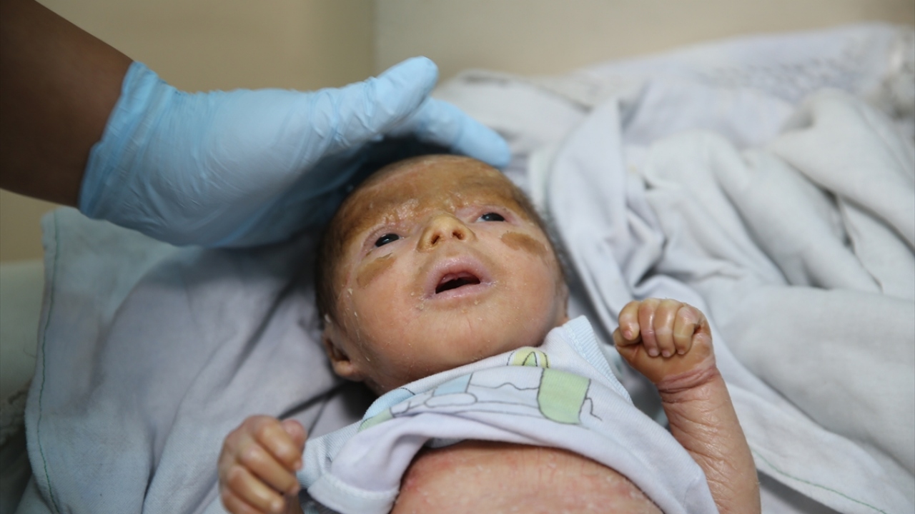 Hatay Valisi Rahmi Doğan, 18 günlük Mutaz`ın Türkiye`de tedavi olabilmesi için çalışma başlattı.