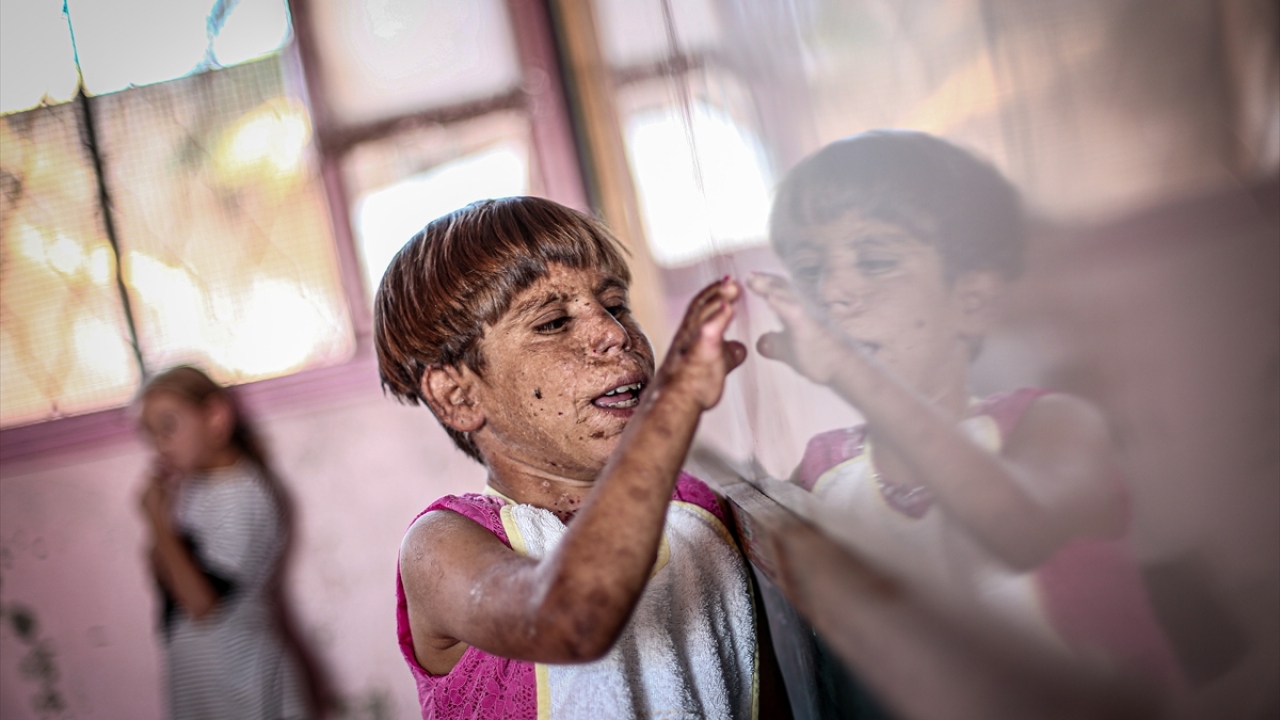 "Hayata ağrı kesicilerle devam ediyor"