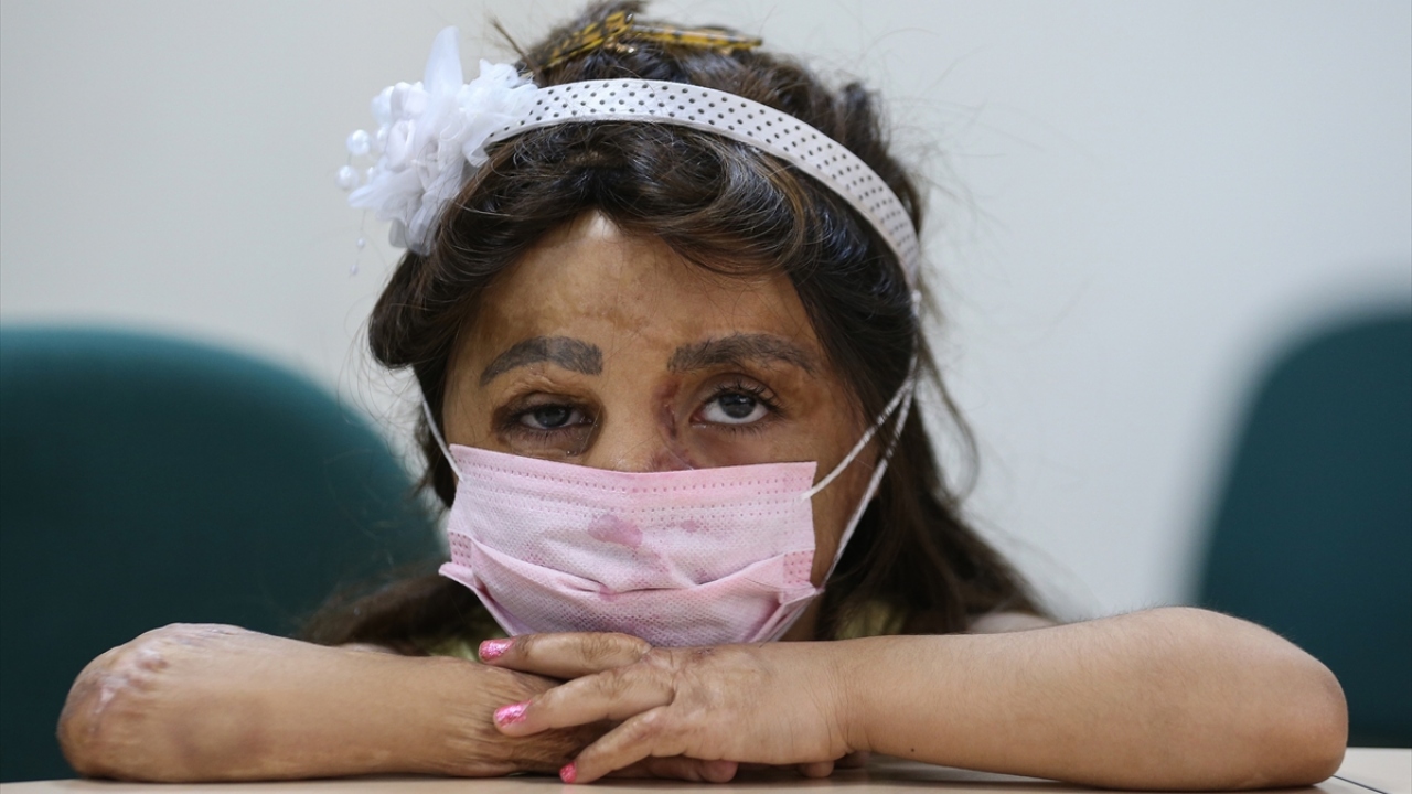 Savaştan kaçan 5 yaşındaki Hane ve ailesi, İstanbul`da yaşayan bir hayırseverin yardımıyla tedavisinin yapılması için 1,5 yıl önce Akdeniz Üniversitesi Hastanesine getirildi.