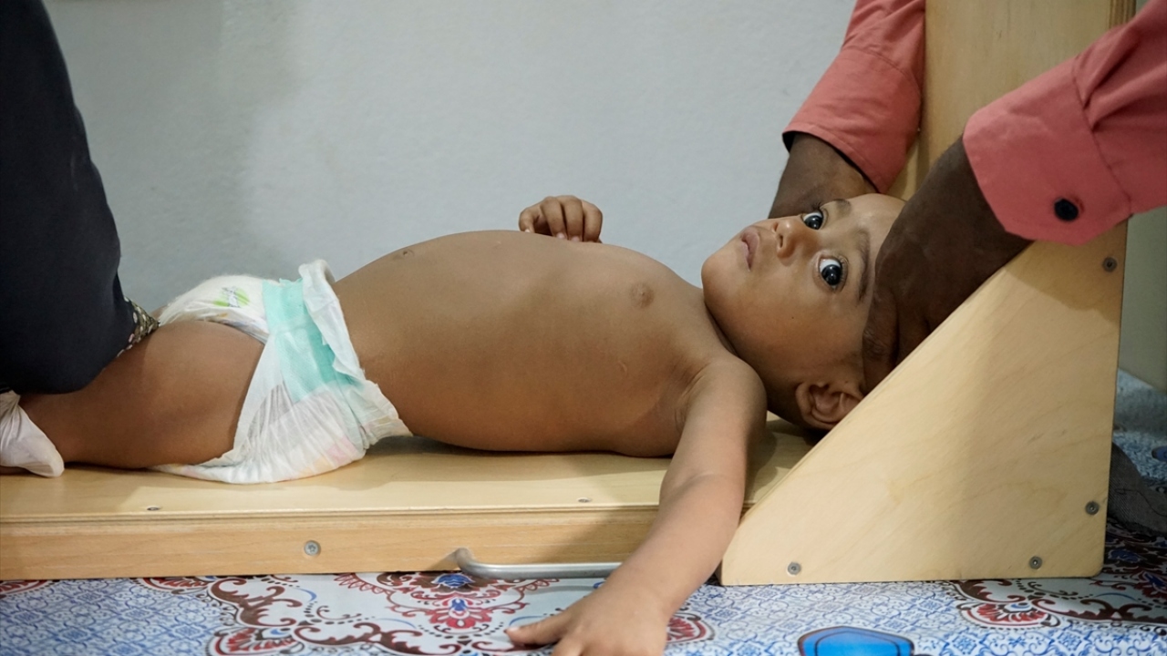 Açlık krizinden etkilenenler arasında 2 milyon çocuk bulunuyor