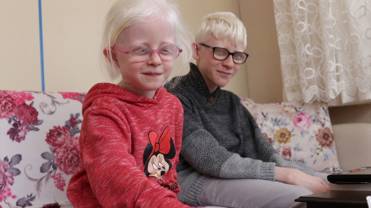 Hüseyin Ali, albinizim hastalığı nedeniyle Güneş tepedeyken dışarı çıkması gerektiğinde çok zorlandığını belirterek, güneşin bazen gözlerini kapatmasına bazen de cildinde ciddi yanıklara sebep olduğunu söyledi.