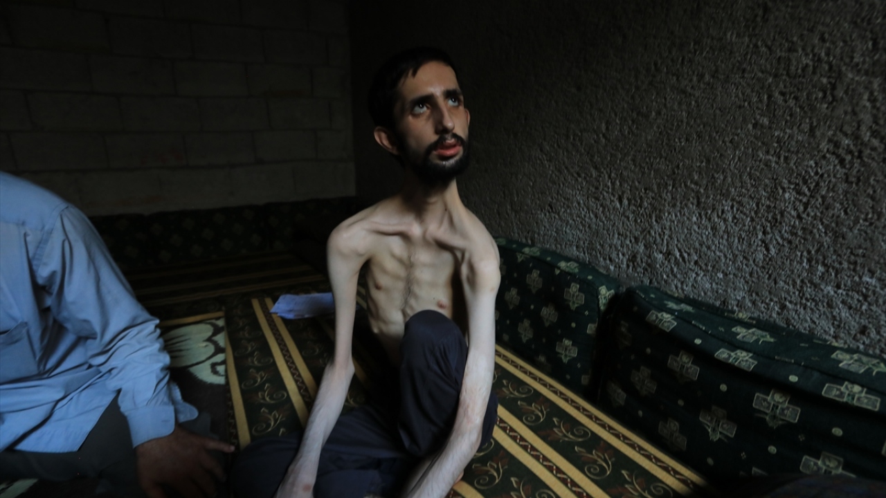 Saldırı sonrası konuşma, yürüme gibi temel fonksiyonlarını tamamen kaybeden Abdullah, sadece sıvı besinler tüketerek hayatta kalma mücadelesi veriyor.