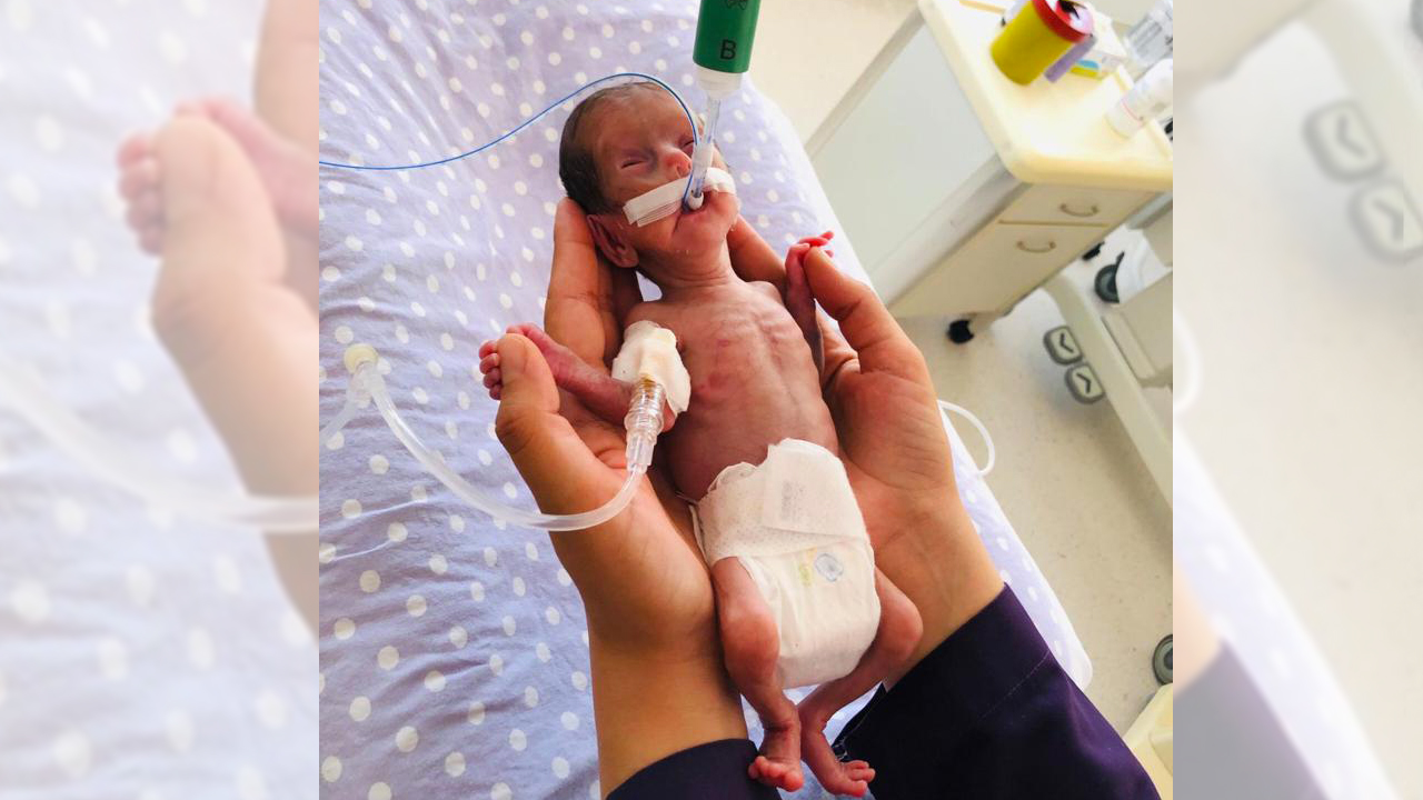 Anne Emete Varış, üçüncü çocuğuna hamile kaldıktan sonra gebeliğinin 23. haftasında ağrılarının artması üzerine doktora başvurdu.