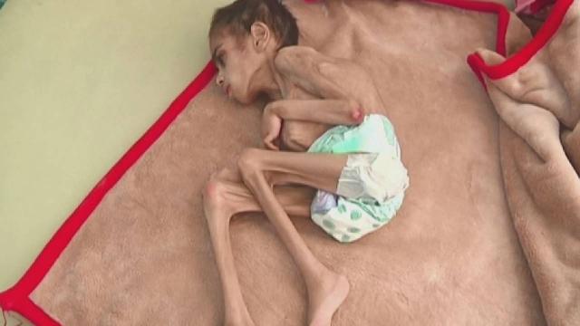 Yemende açlıktan ölenlere bu yıl milyonlarca kişi eklenebilir