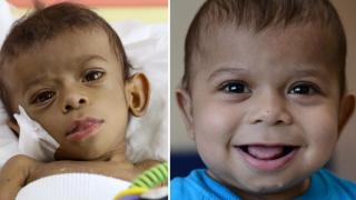 Suriyeli minik Tamer için organ seferberliği