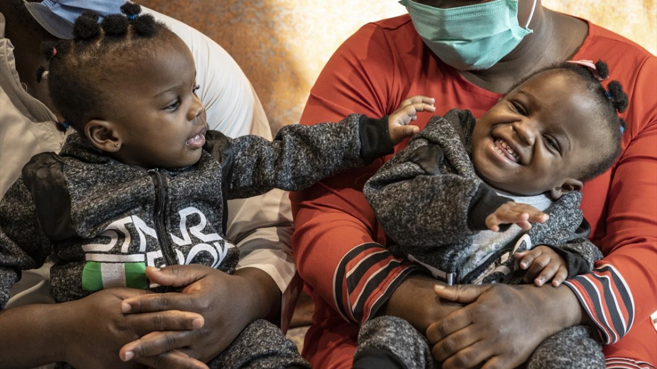 "Ayırma ameliyatı yaklaşık 27 saat sürdü"