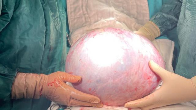 Karnından 9 kilo tümör çıktı