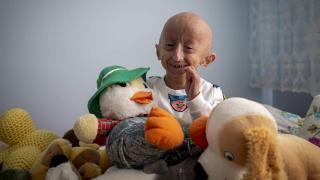 Bedeni hızla yaşlanan 9 yaşındaki Veysel, iyileşebilme umudunu asla kaybetmiyor