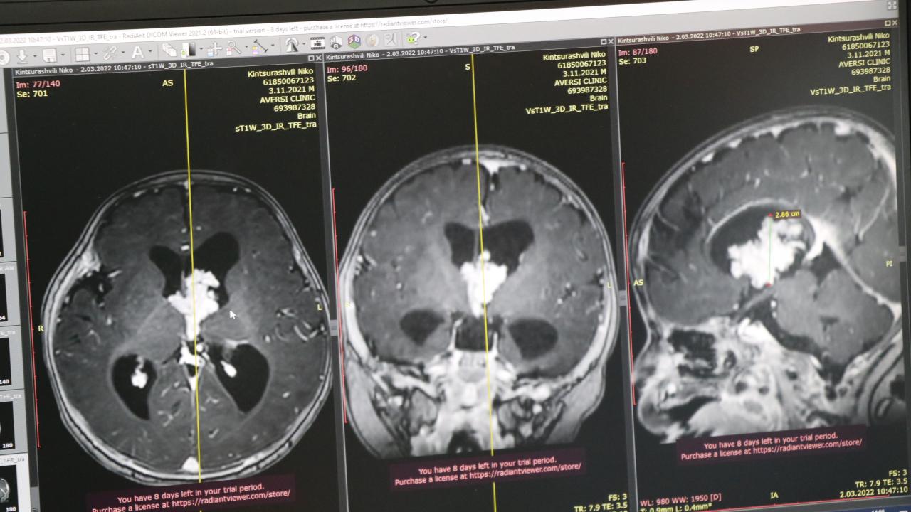 “Santral sinir sistemi tümörleri müdahale edilmezse ölümcül tümörlerdir”