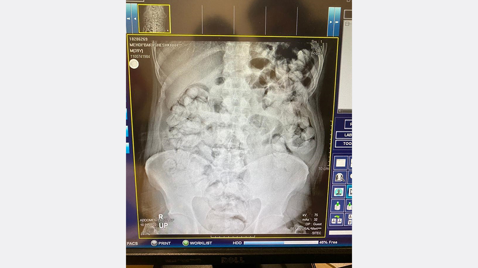 Vücuda uyuşturucu koyma yöntemi şaşırttı