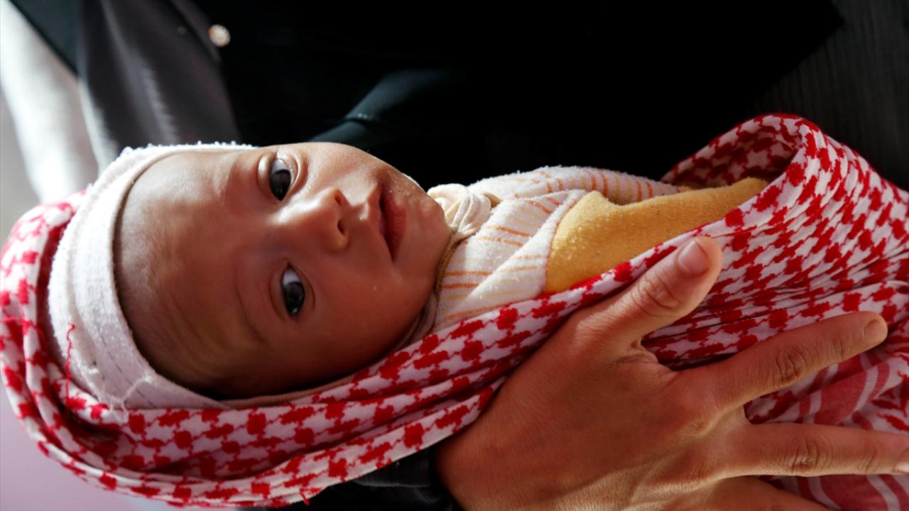 Yemen'de yarım milyon çocuğun hayatı yetersiz beslenme nedeniyle tehlikede