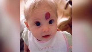 Damar yumaklarını küçültmek mümkün