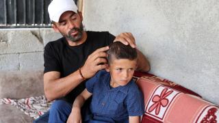 Köpek ısırması nedeniyle 6 ameliyat geçiren Emir'in başında izleri kaldı