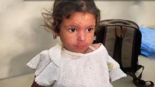 Gazze'de cilt hastalıkları bombaların altında büyüyen çocuklar arasında yayılıyor