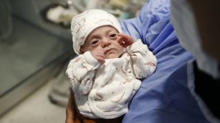380 gram doğan bebek 155 günlük mücadeleyle yaşama tutundu
