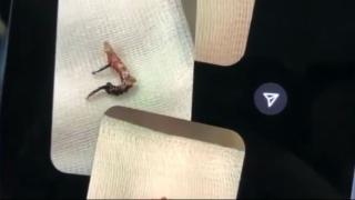 Burnuna kaçan küpeyle senelerce yaşadı