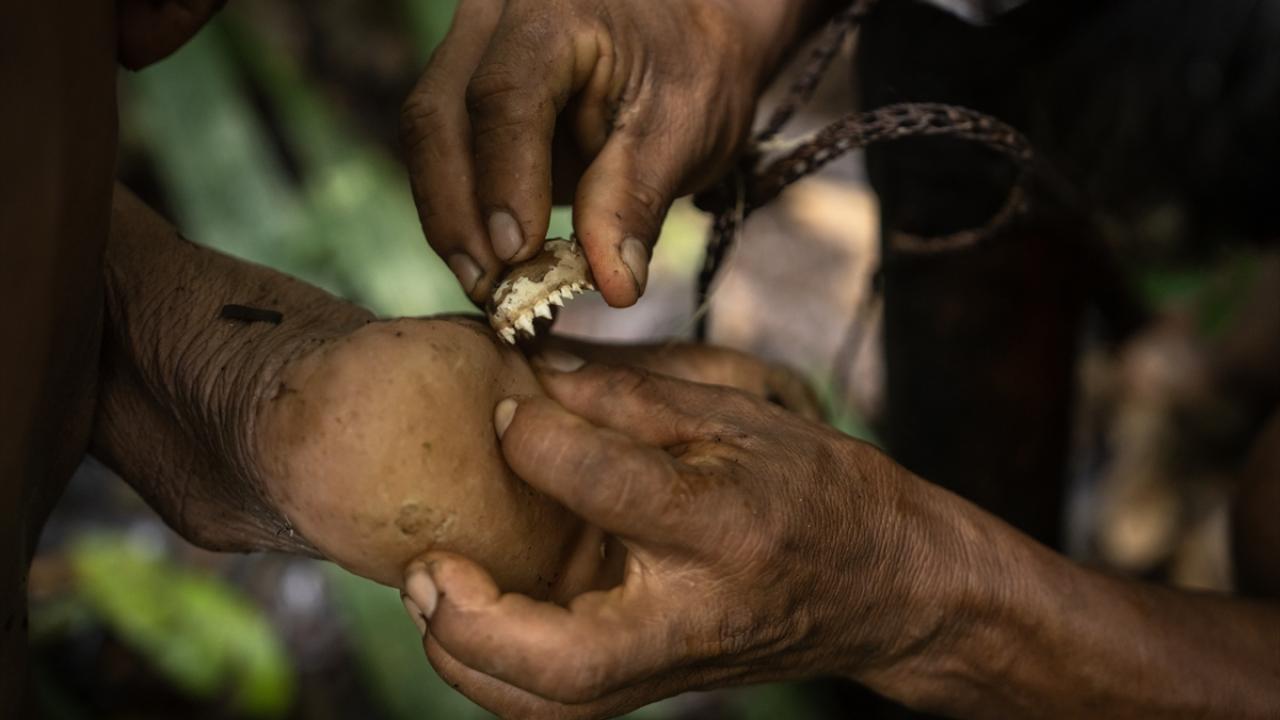 Ayaklarına batan cismi, piranaların dişleriyle çıkarıyorlar