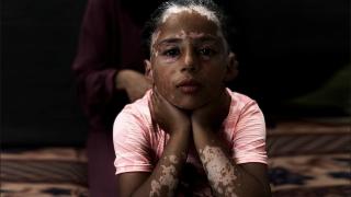 İsrail'in saldırıları nedeniyle 10 yaşında saçına ak düştü