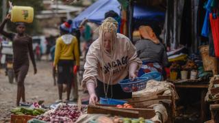 Hem güneşle hem de toplumsal ayrımcılıkla mücadele eden Afrikalı albinolu Catherine
