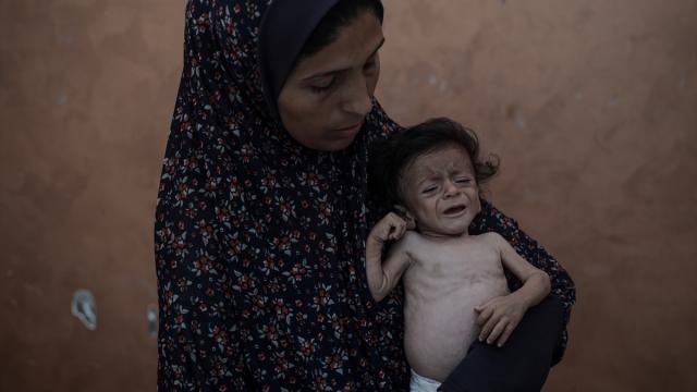 Gazze’de 5 aylık bebek açlık nedeniyle hayati tehlike altında