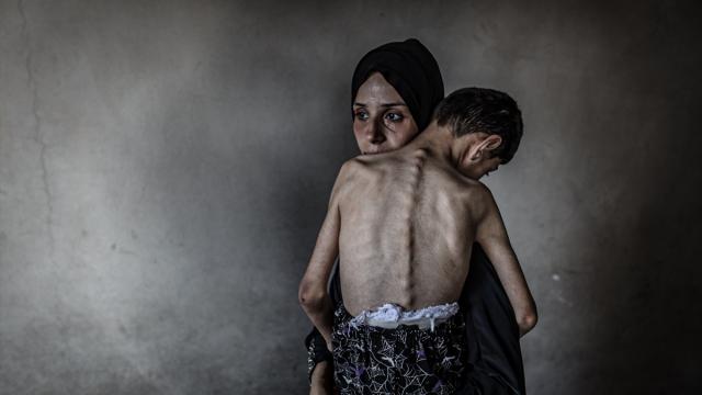 Gazze'deki açlık nedeniyle yetersiz beslenme yaşayan çocukların sayısı artıyor