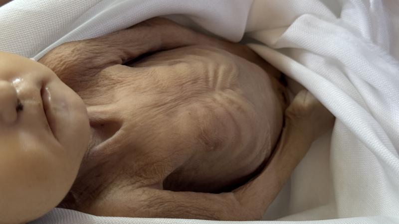 Qəzzada daha 10 nəfər aclıqdan ölüb