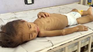 Gazze'de açlık savaşı: 2 yaşındaki İmad yaşam mücadelesi veriyor