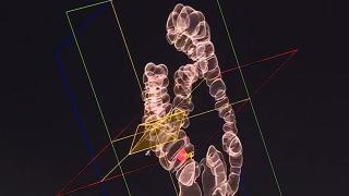 Sanal kolonoskopi ile hızlı tarama