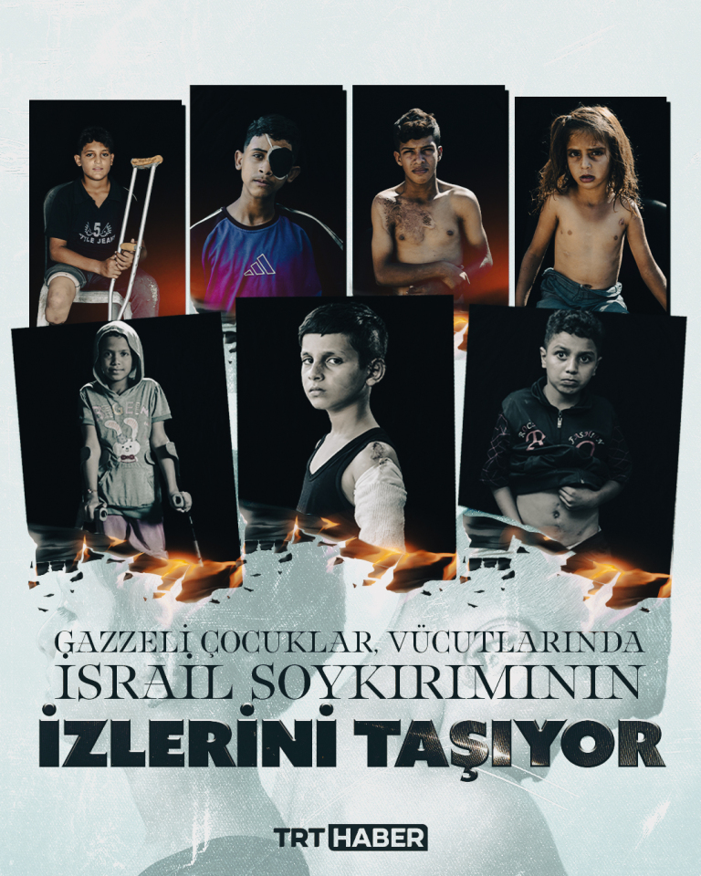 Gazzeli çocuklar, vücutlarında İsrail soykırımının izlerini taşıyor
