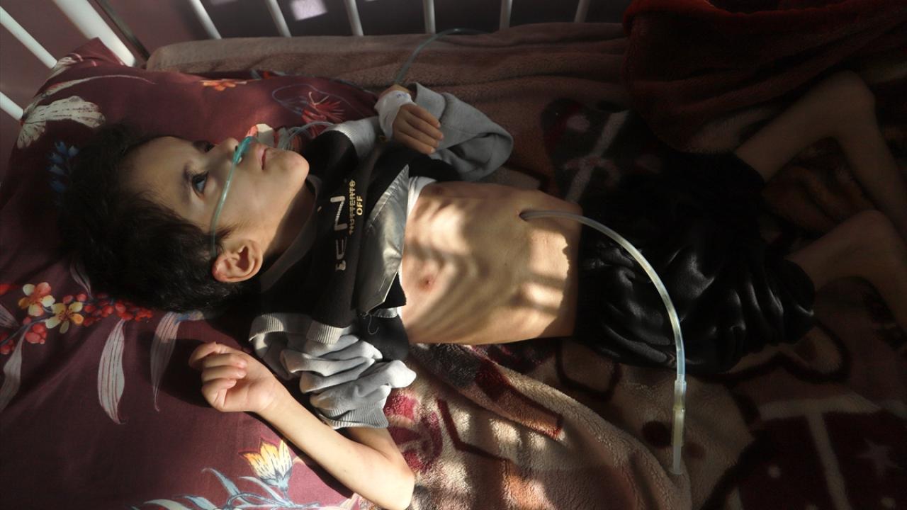 Yetersiz beslenme sorunu yaşayan Filistinli çocuk yaşam mücadelesi veriyor