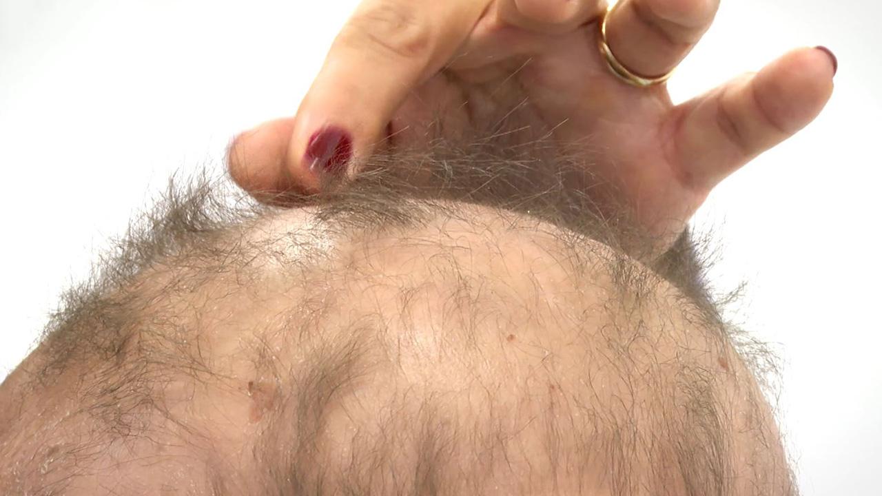 10 yaşındaki Haydar Talha Kandemir saçkıran hastalığını yendi