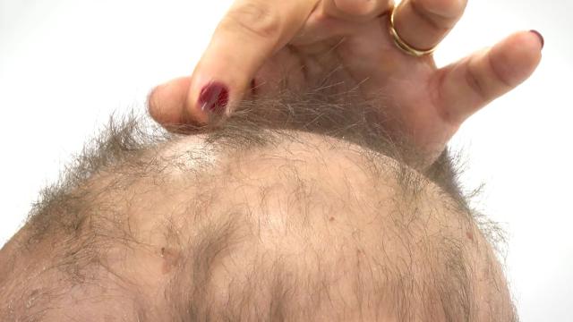 10 yaşındaki Haydar Talha Kandemir saçkıran hastalığını yendi