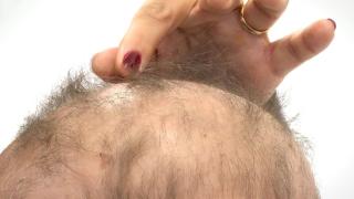 10 yaşındaki Haydar Talha Kandemir saçkıran hastalığını yendi