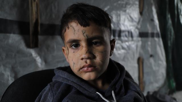 İsrail saldırısında gözlerini kaybeden Filistinli çocuk hayatta kalma mücadelesi veriyor