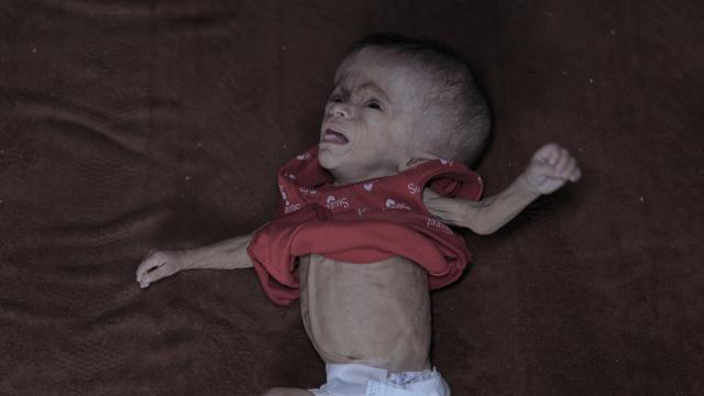 Yetersiz beslenme sorunu yaşayan Filistinli bebek, yaşam mücadelesi veriyor