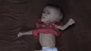 Yetersiz beslenme sorunu yaşayan Filistinli bebek, yaşam mücadelesi veriyor