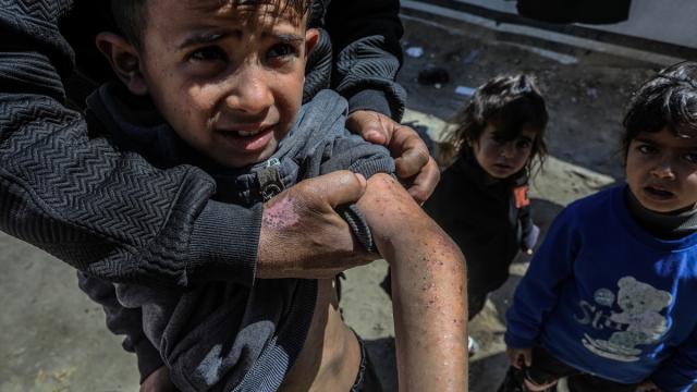 Gazze'deki çadır kamplarında aşırı kalabalık ve su sıkıntısı, kronik cilt hastalıklarına yol açıyor