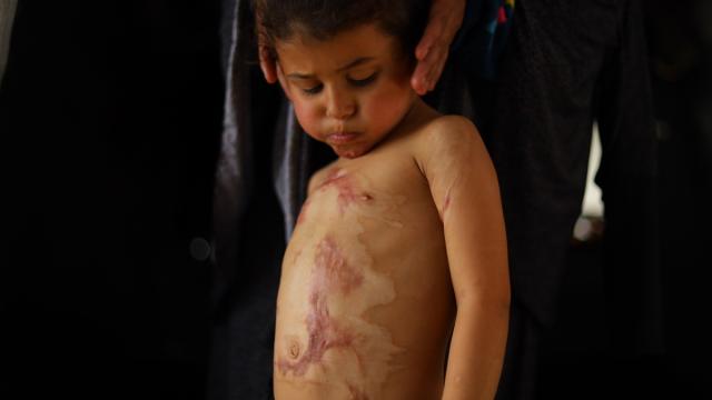 İsrail saldırısında ağır yaralanan Gazzeli küçük Rital, yaşam mücadelesi veriyor