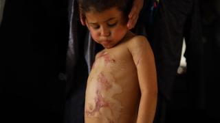 İsrail saldırısında ağır yaralanan Gazzeli küçük Rital, yaşam mücadelesi veriyor