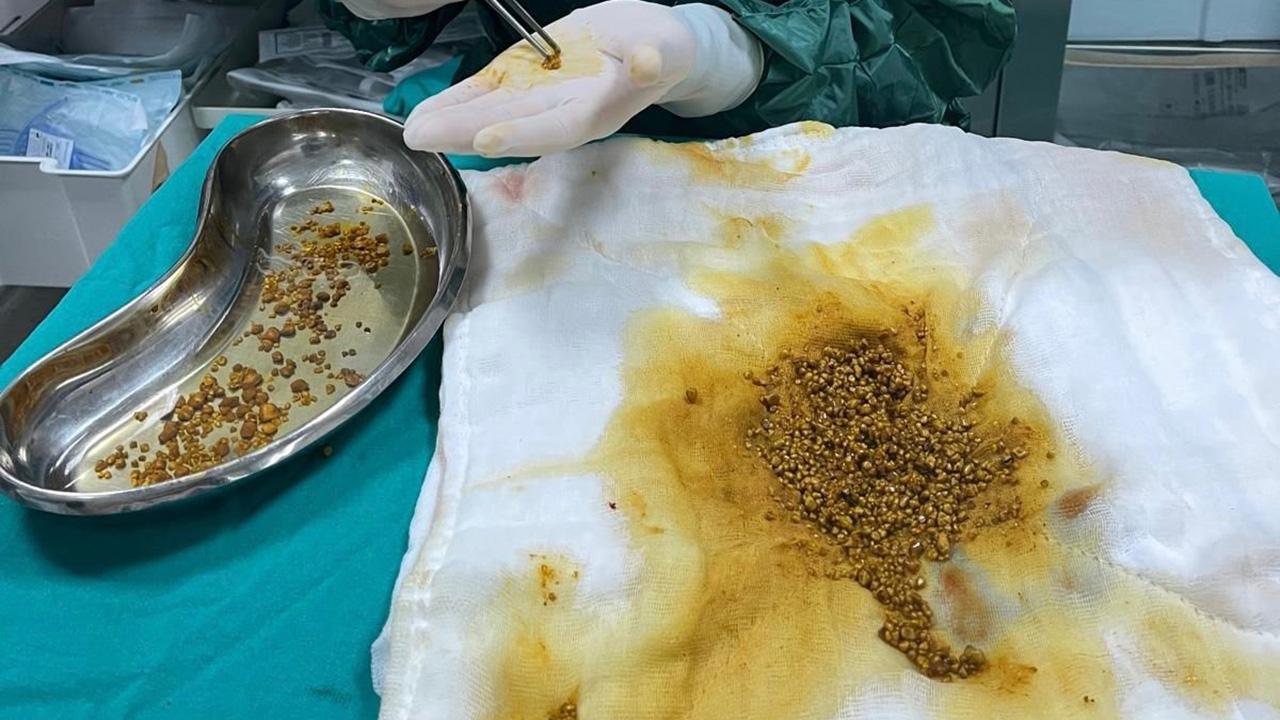 Hastanın ameliyatında 2 bin 67 taş çıkarıldı