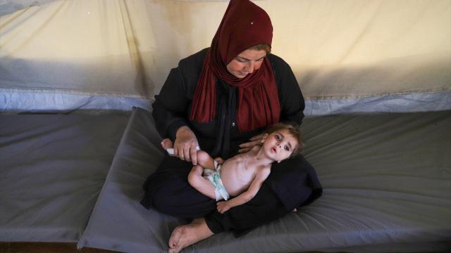 Yetersiz beslenme sorunu yaşayan Filistinli bebek, yaşam mücadelesi veriyor