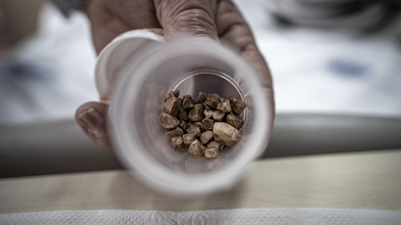 İdrar kanalından 51 taş çıkarıldı