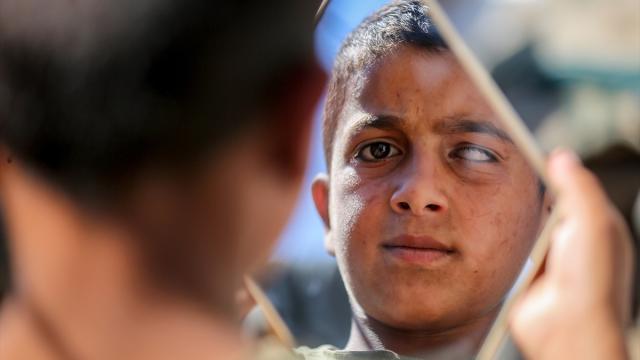 İsrail askerinin darbetmesi sonucu bir gözünü haybeden Gazzeli çocuk protez göze ihtiyaç duyuyor