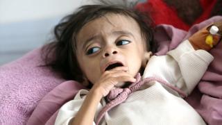 Yemen'de yetersiz beslenen çocuklar kısıtlı imkânlarla hayata tutunuyor